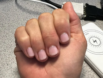 nail biting success with hypnosis - 1