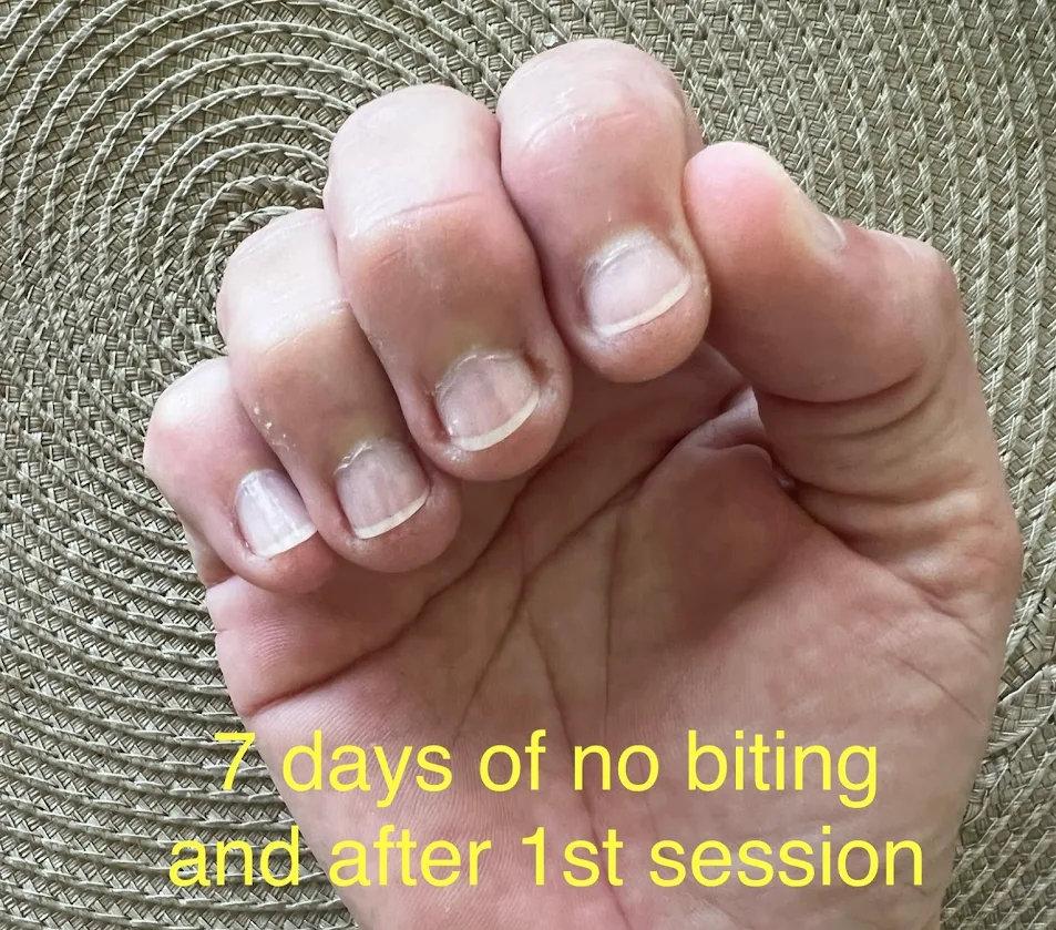 Client's healed, healthy nails after quitting nail biting with hypnosis